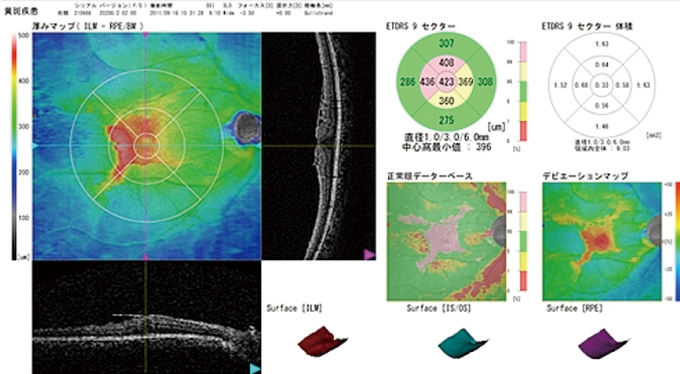 眼底 三次 元 画像 解析 と は