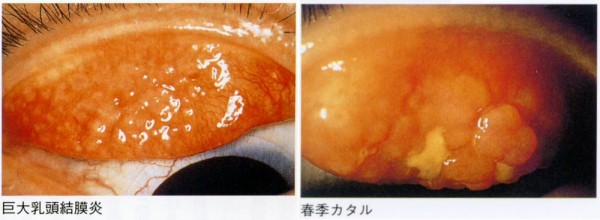 巨大 乳頭 結膜炎 目薬