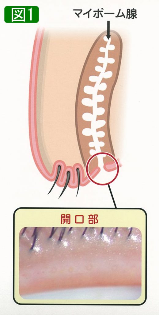 マイボーム 腺 梗塞